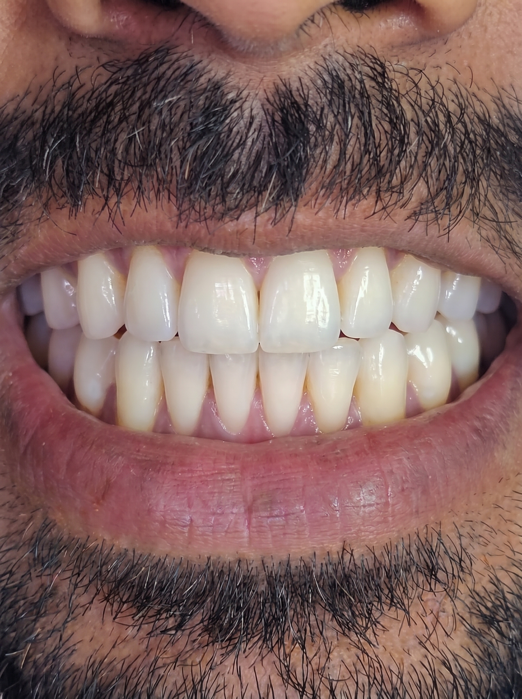 Smile Makeover - After treatment