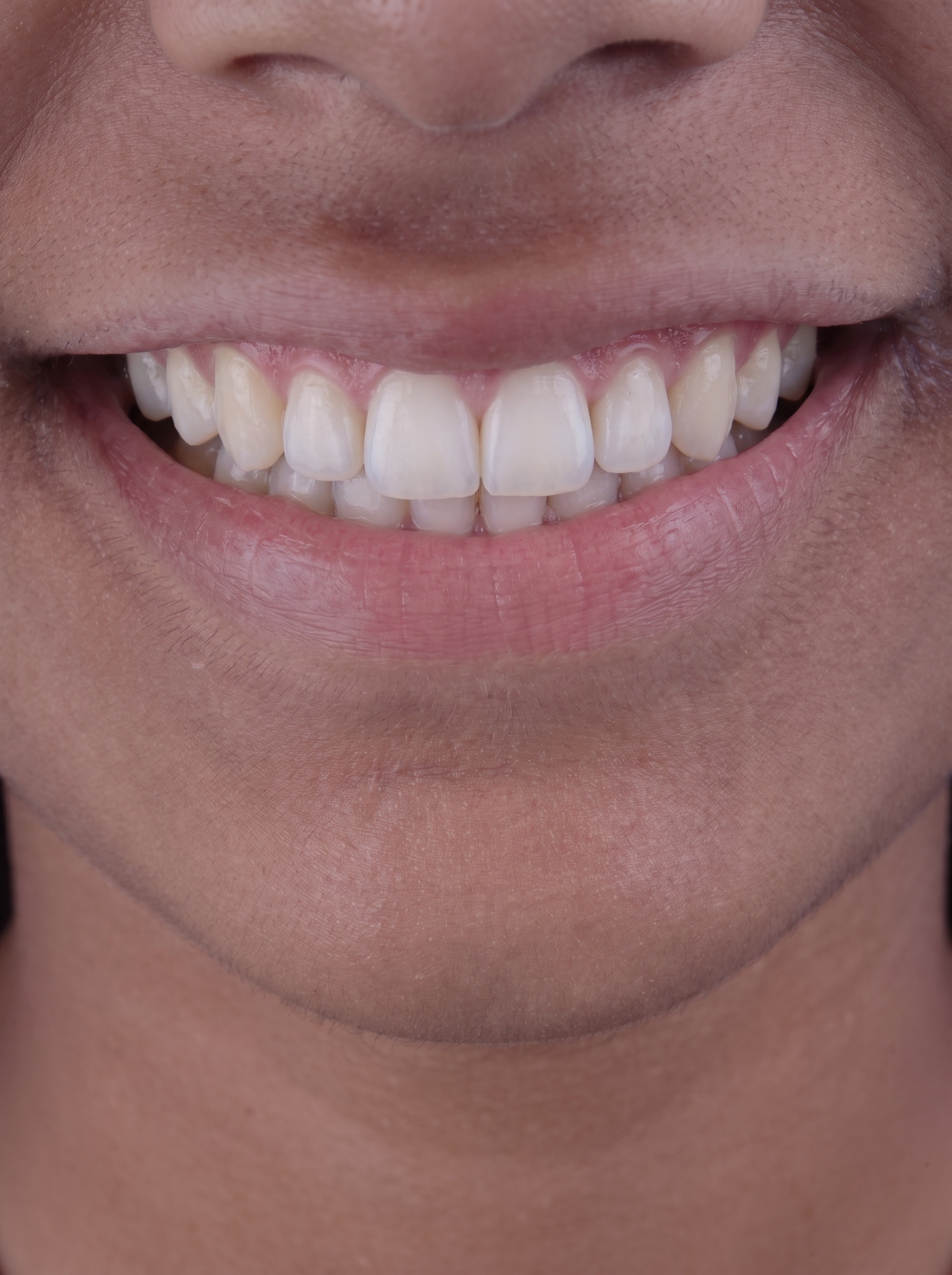 Teeth Whitening & Alignment - After treatment