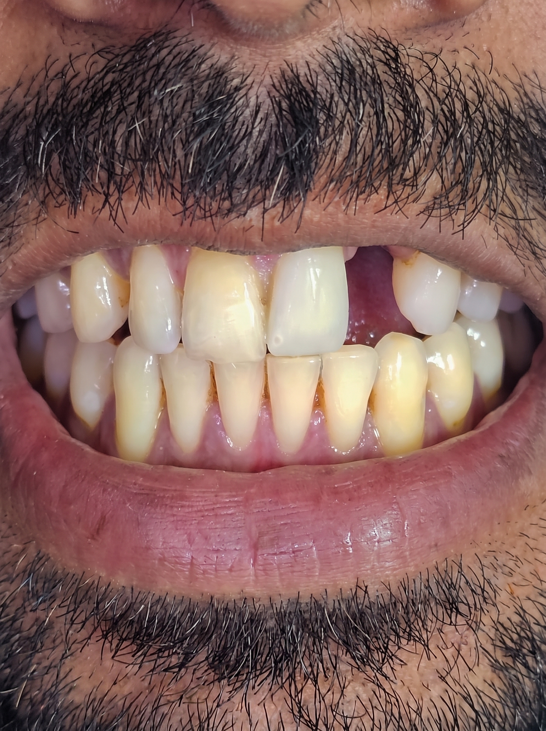 Smile Makeover - Before treatment