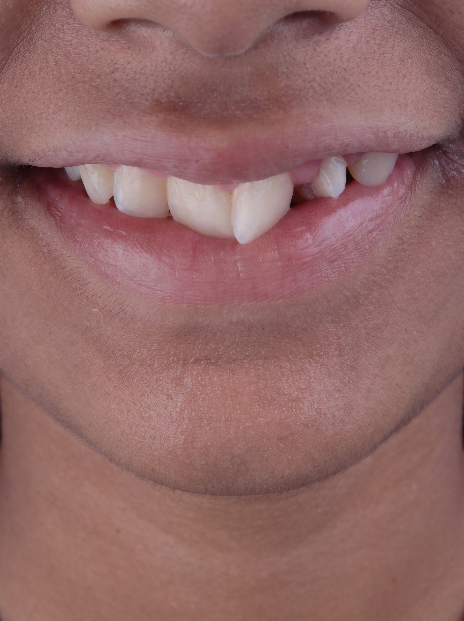 Teeth Whitening & Alignment - Before treatment